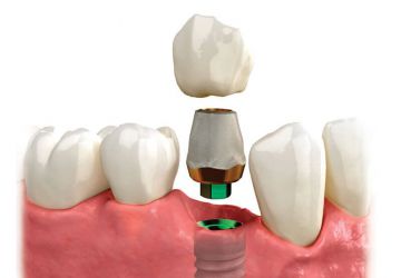 بررسی و معاینه ایمپلنت دندان