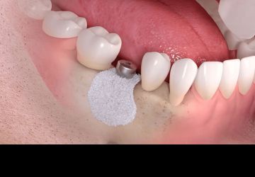 علل مؤثر بر موفقیت ایمپلنت دندان