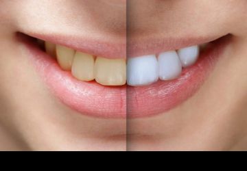 بلیچینگ دندان ضرر هم دارد؟