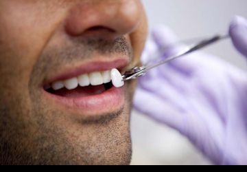  انجام لمینت دندان چه شرایطی دارد؟